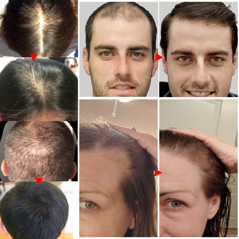 2023 Biotin schnelles Haarwuch – Epidermal Growth Factor Bewertung und Preis