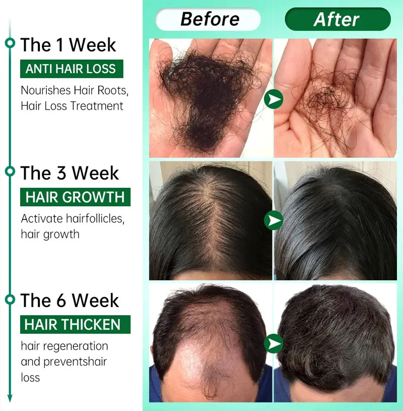7-Tage Schnelles Haarwuchsseru – Epidermal Growth Factor Bewertung und Preis